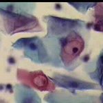 Περιπυρηνική άλω, ενδεχομένως κοιλοκυττάρωση